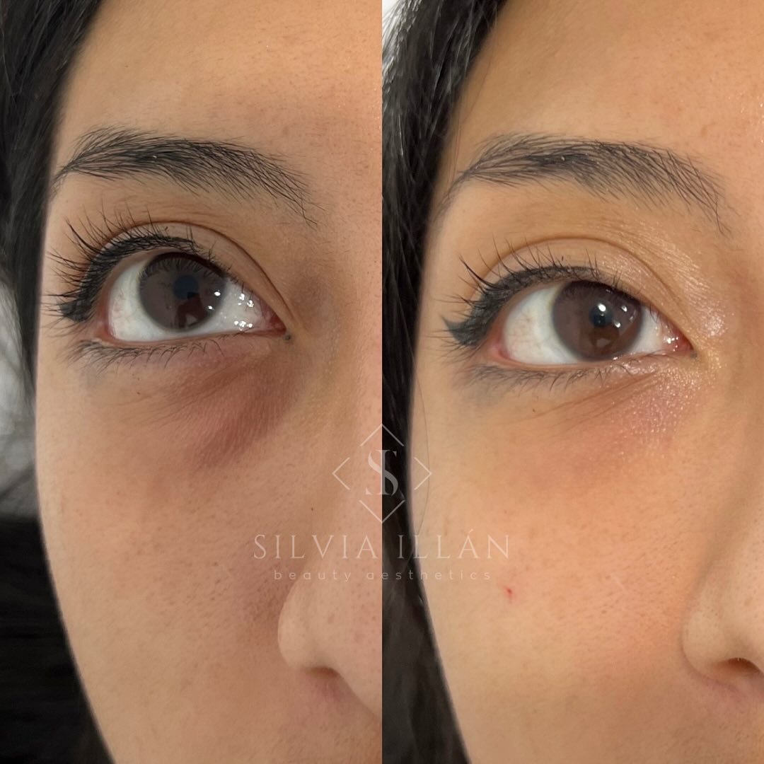 Relleno de ojeras
