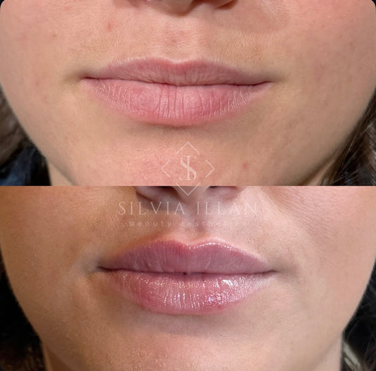 Aumento/ hidratación de labios