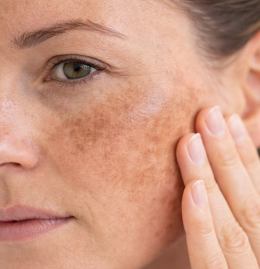 Tratamiento para el melasma. Dermamelan