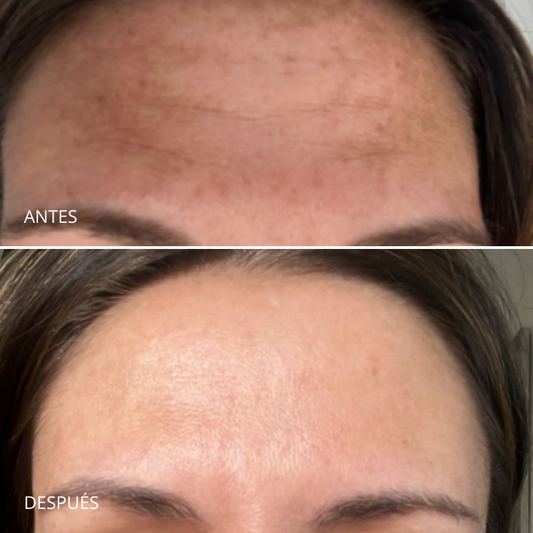 Pack Despigmentante Melasma. Dermamelan