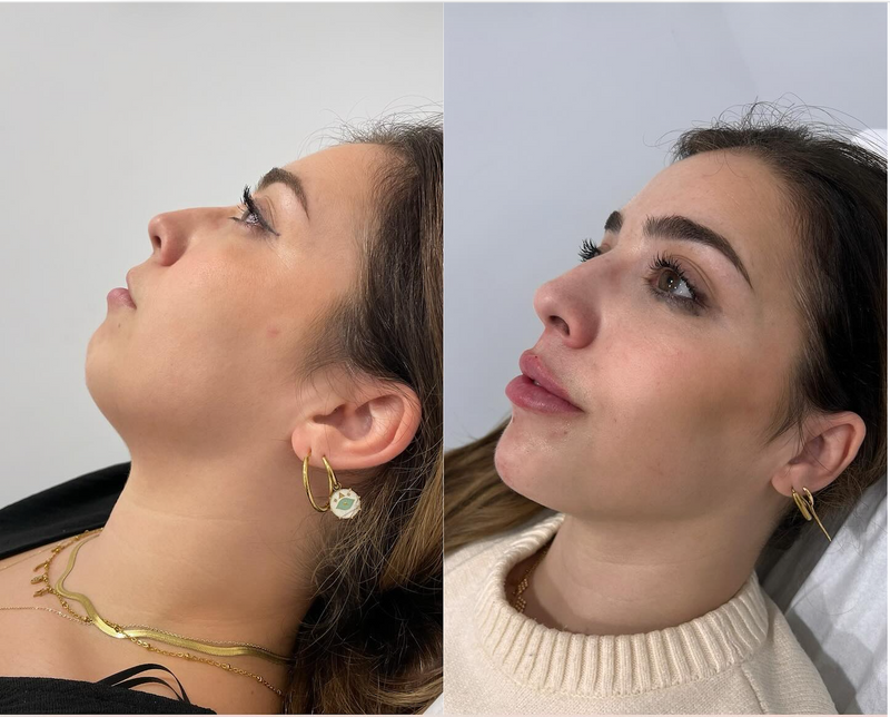 Marcación Mandibular