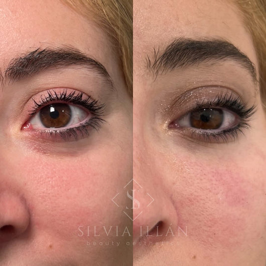 Relleno de ojeras