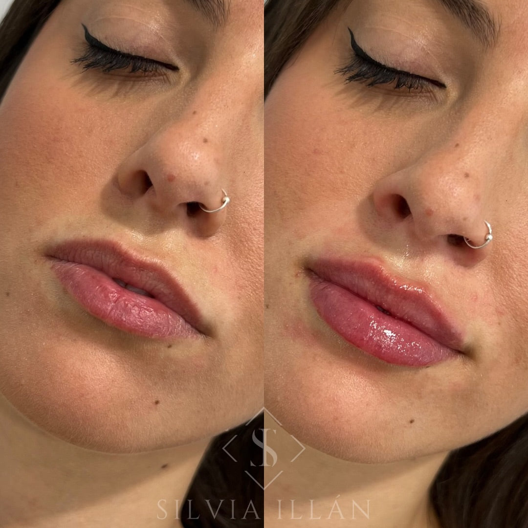 Aumento/ hidratación de labios