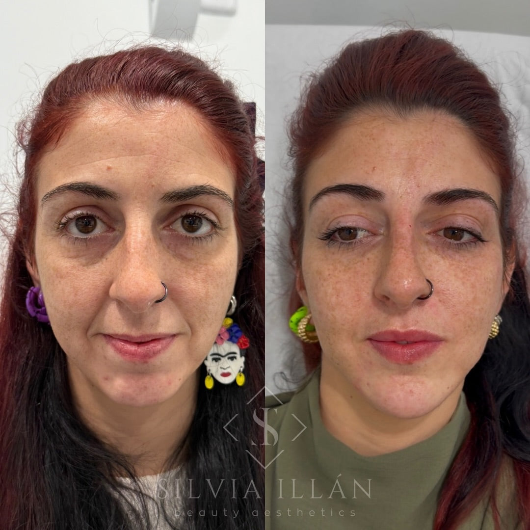 Armonización facial