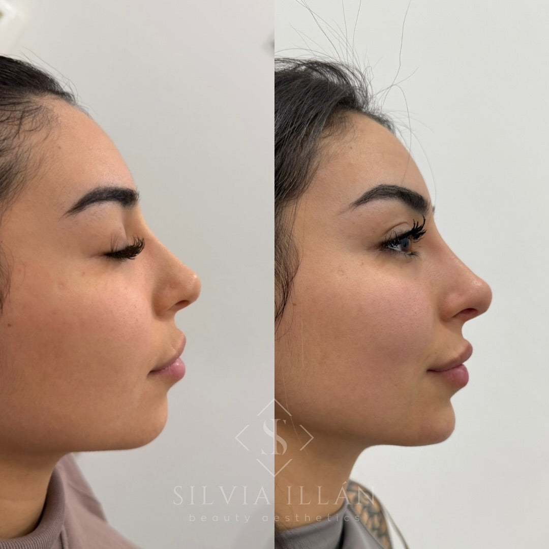 Armonización facial