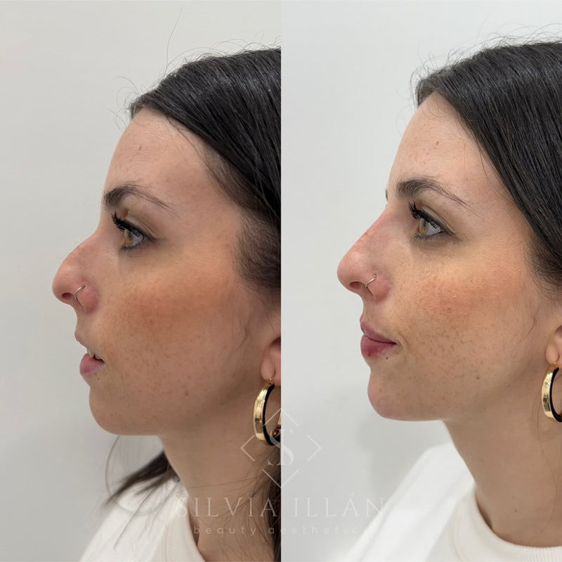 Armonización facial