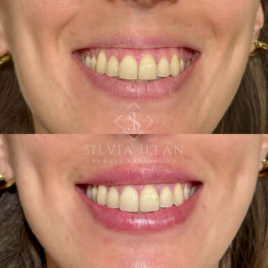 Sonrisa Gingival
