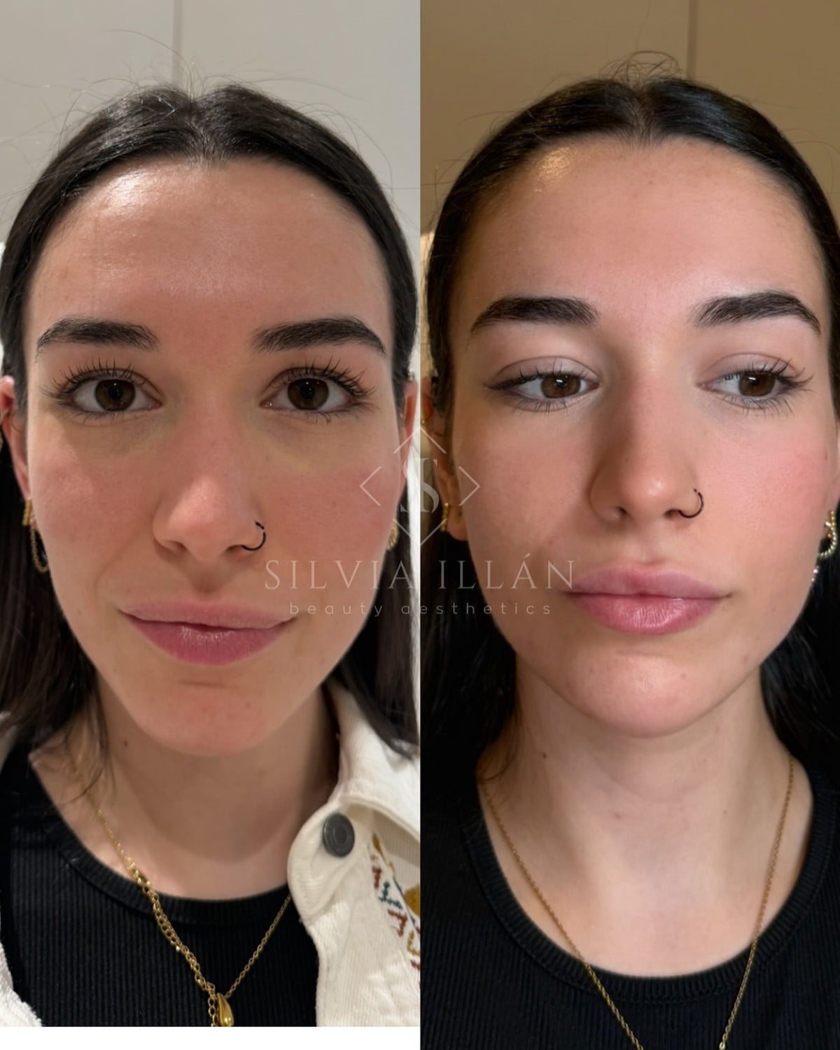 Armonización facial