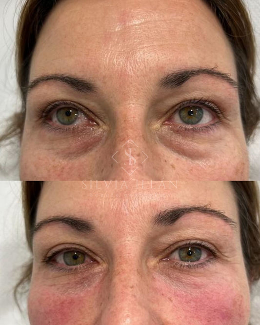 Relleno de ojeras