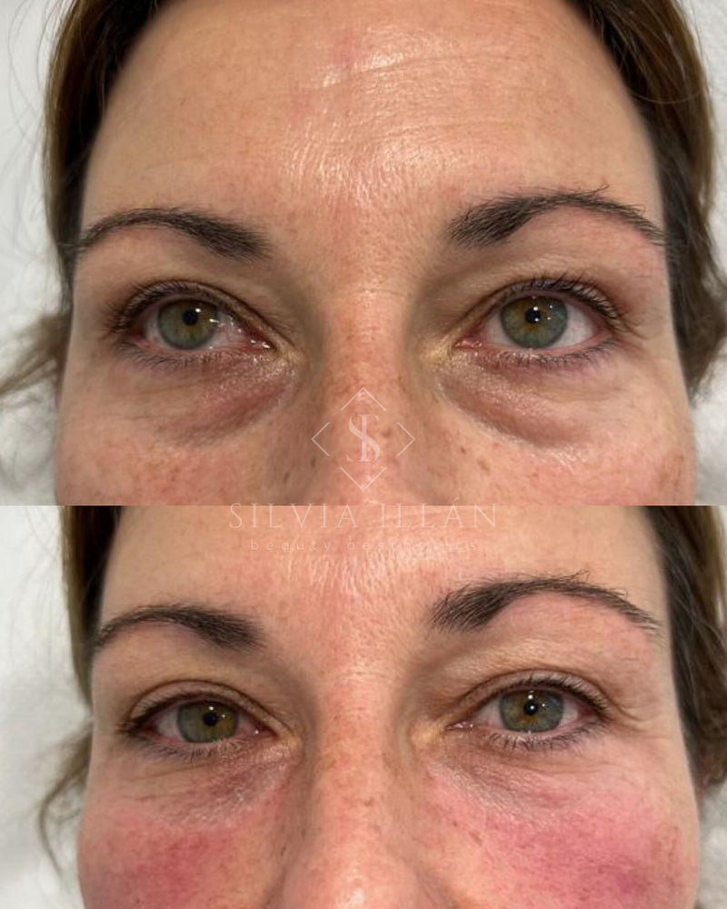 Relleno de ojeras