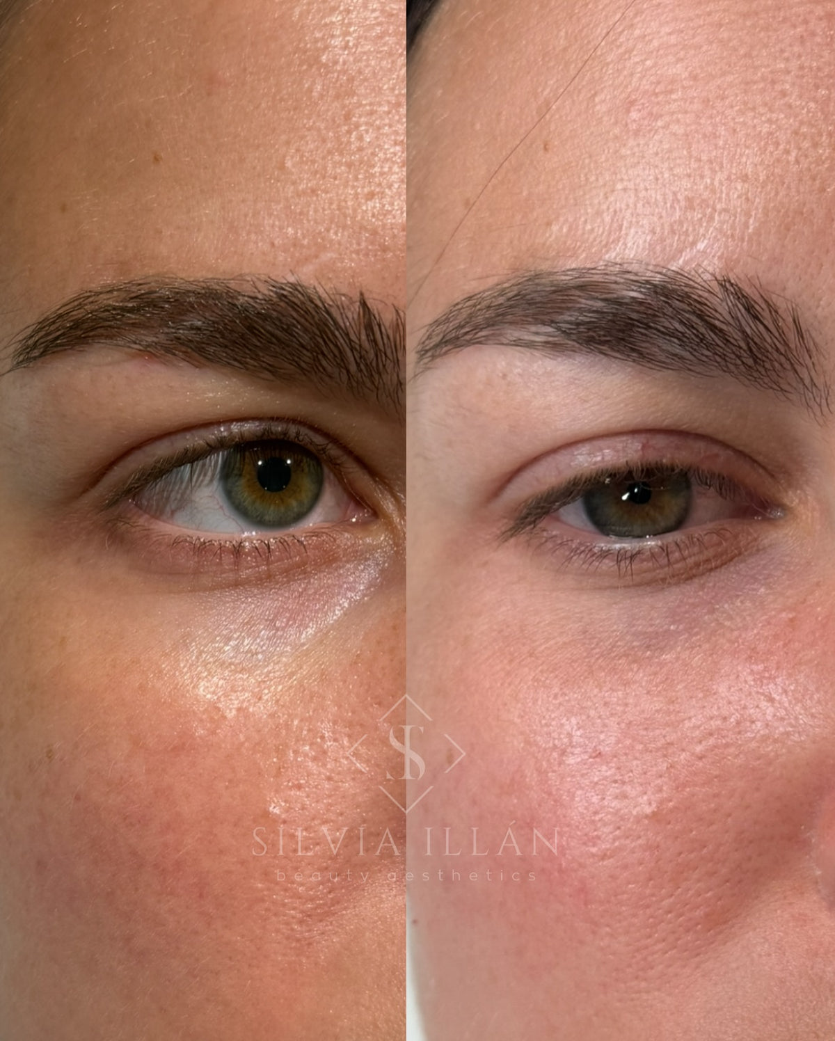 Relleno de ojeras