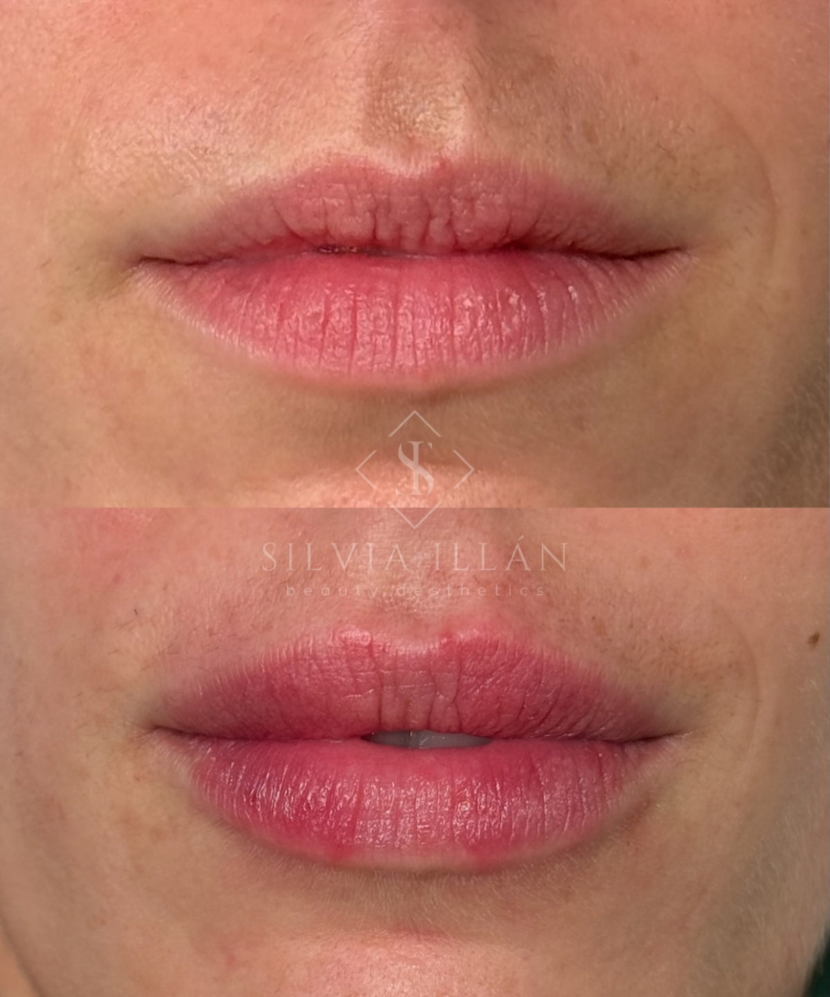 Aumento/ hidratación de labios