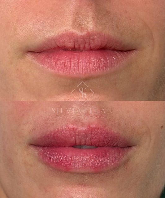 Aumento/ hidratación de labios