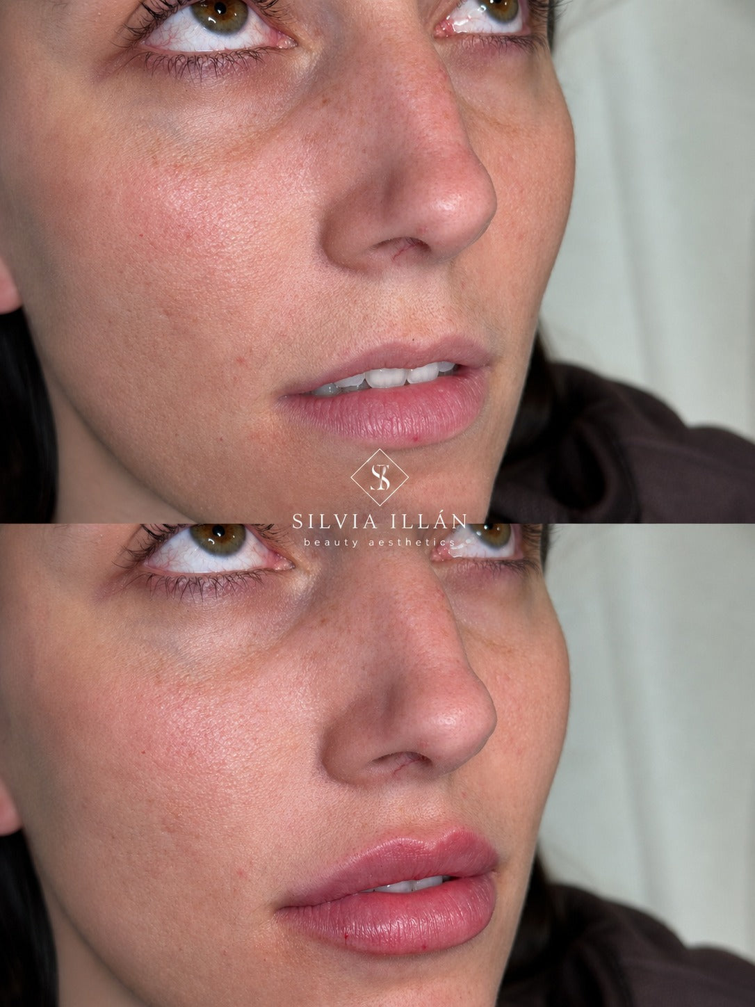 Aumento/ hidratación de labios